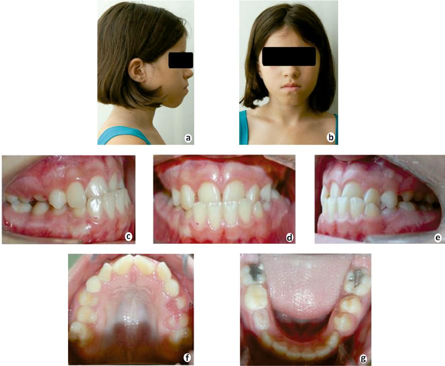 Bezerra JO, Silva AM, Peixoto MGS, Tiago CM metria facial, aumento do terço inferior, selamento labial e deficiência na região malar.