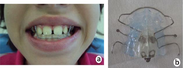 Figura 5. Evolução do tratamento. (a) Paciente com arco de Eschler em posição e (b) aparelho arco de Eschler visto separadamente. Figura 6.