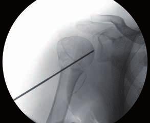 O fio deve ser inserido na direção do coracoide a uma inclinação de aproximadamente 20 para permitir a retroversão anatômica da cabeça umeral (Fig. 9, 10). Fig.