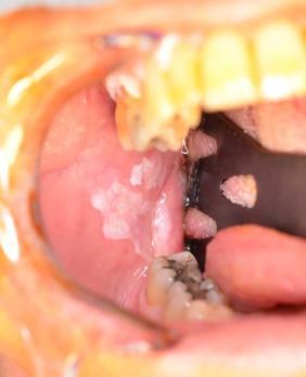 Leucoplasia Oral LO é definida pela OMS como uma mancha branca que não pode ser raspada ou removida e não é atribuível a qualquer fisiopatologia ou processo de doença.