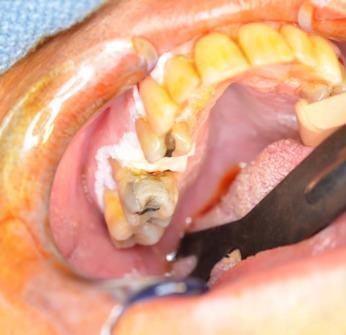 Figura 2: Leucoplasia verrucosa proliferativa que afeta a gengiva maxilar e o palato duro.