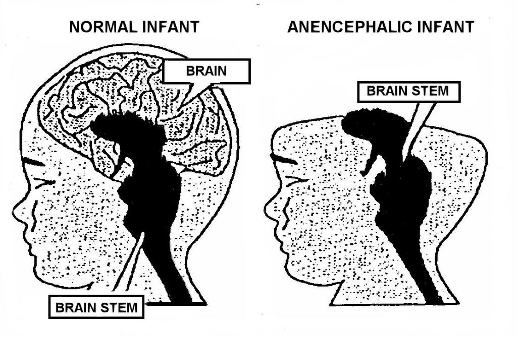 Esquema geral da Anencefalia NORMAL NORMAL HEMISFÉRIOS CEREBRAIS ANENCEFALIA TRONCO