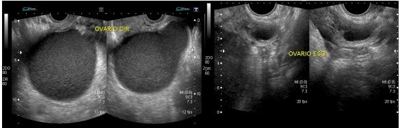 54 Apresentação ecográfica da endometriose alcançar locais como a cicatriz umbilical (Figura 7) e a parede abdominal (Figura 8).