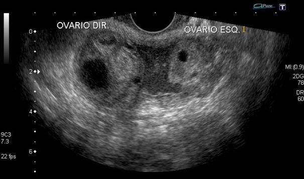 Focos endometrióticos também podem estar localizados no miométrio, por vezes simulando principalmente miomas uterinos (Figura 10).