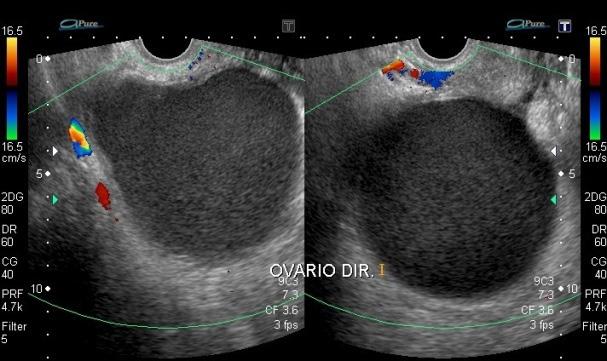 A B Nota: Formação cística (imagem à direita) com características de endometrioma em ovário esquerdo, conforme descrito anteriormente; observa-se outra formação cística em ovário direito, de paredes