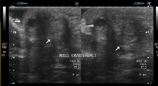 fossa ilíaca esquerda, consistente com foco endometriótico. Figura 7. Encometriose em cicatriz umbilical.