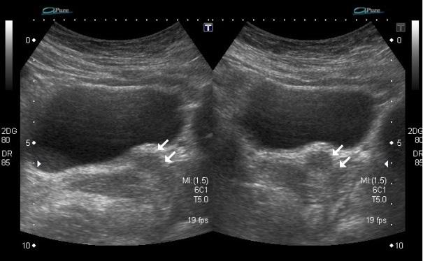 Nota: Paciente com 26 anos apresenta queixa de sangramento intermitente através da cicatriz umbilical há 8 meses.