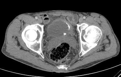 quimioterapia neoadjuvante com