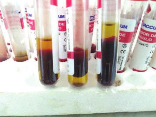 21 Figura 3 - Amostras de sangue para realização do teste do antígeno acidificado tamponado. Observa-se a coagulação com separação do soro sanguíneo.