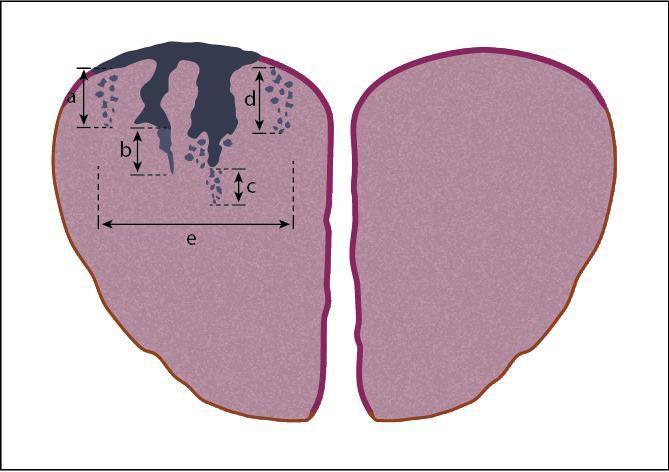 Figura 2: Medição da largura e da profundidade da invasão em tumores do colo do útero As áreas coradas a azul-escuro representam neoplasia intraepitelial do colo do útero 3 (CIN3) com envolvimento