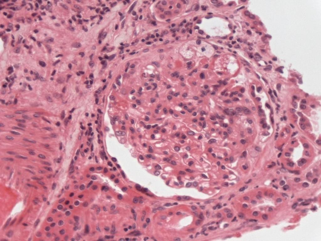 34 FIGURA 9- Variante CEL da GESF, presença de hipercelularidade endocapilar, com células de aspecto xantomatoso (HE, 400x) 4.