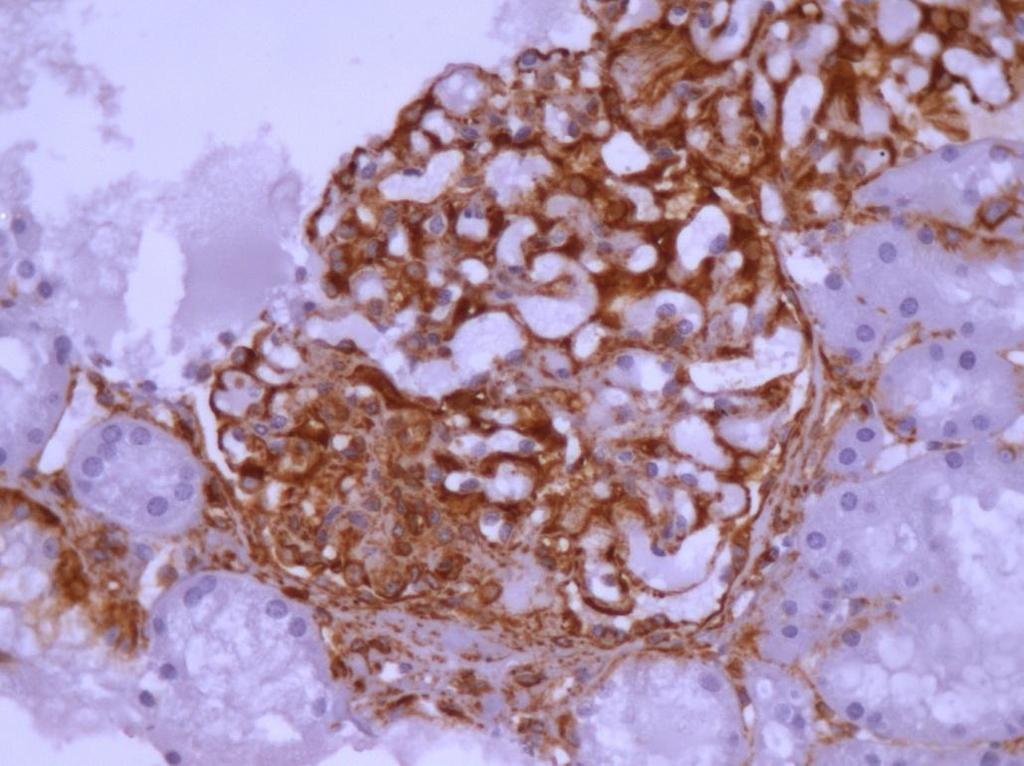 400x) FIGURA 13- Glomérulo de GESF NOS com imunoexpressão