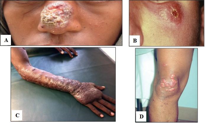 INTRODUÇÃO Figura 1.4: LCL, causada por L. infantum (A) e (B); LCD, causada por L. aethiopica (C); Paciente da Etiópia com múltiplas lesões no joelho (D) (Adaptado de Boelaert & Sundar.