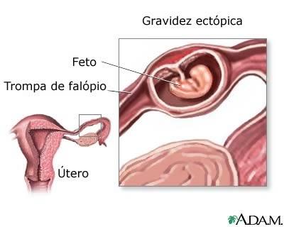 Controle rigoroso dos SSVV; Orientação quanto: repouso, medicação, exames; Apoio psicológico. Complicações: Hemorragia; Perfuração uterina; Infecção: Esterilidade.