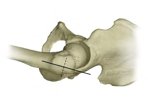 1. Preparação do Fêmur Após a luxação da cabeça femora, realize a osteotomia do colo femoral num ângulo de 45º,mantendo a parte