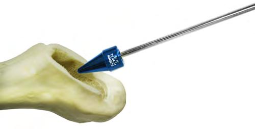 10. Retirada da Raspa/Teste Após feito o teste da Cabeça femoral, retire o Cone Teste (TT.64), acople o cabo RP.20.