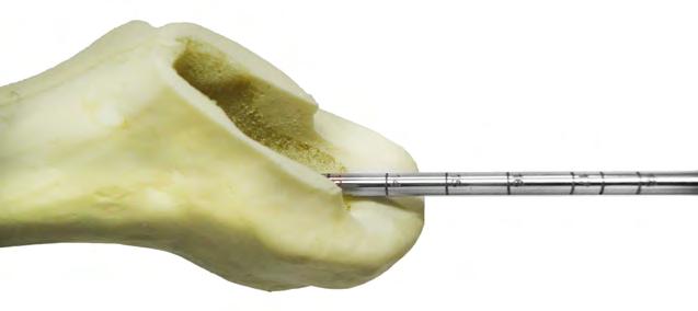 20 escalonado até a marca de 160 mm, que corresponde ao tamanho do implante adicionado com a distância do centralizador