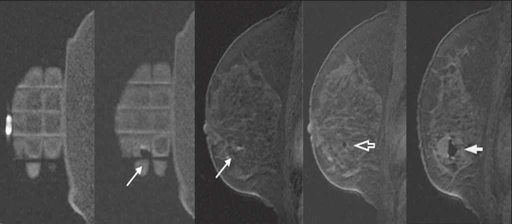 A B C D E Figura 3. RM, sagital T1 com supressão de gordura, de mulher com 53 anos submetida a biópsia a vácuo (abordagem: mama esquerda, lateral). A: Imagem da cápsula de vitamina e grade.