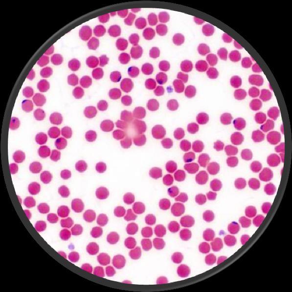 Os protozoários alojam-se no fígado, onde maturam e se reproduzem. Alguns dias depois abandonam o fígado e invadem os glóbulos vermelhos, multiplicando-se e fazendo com que estes rebentem.