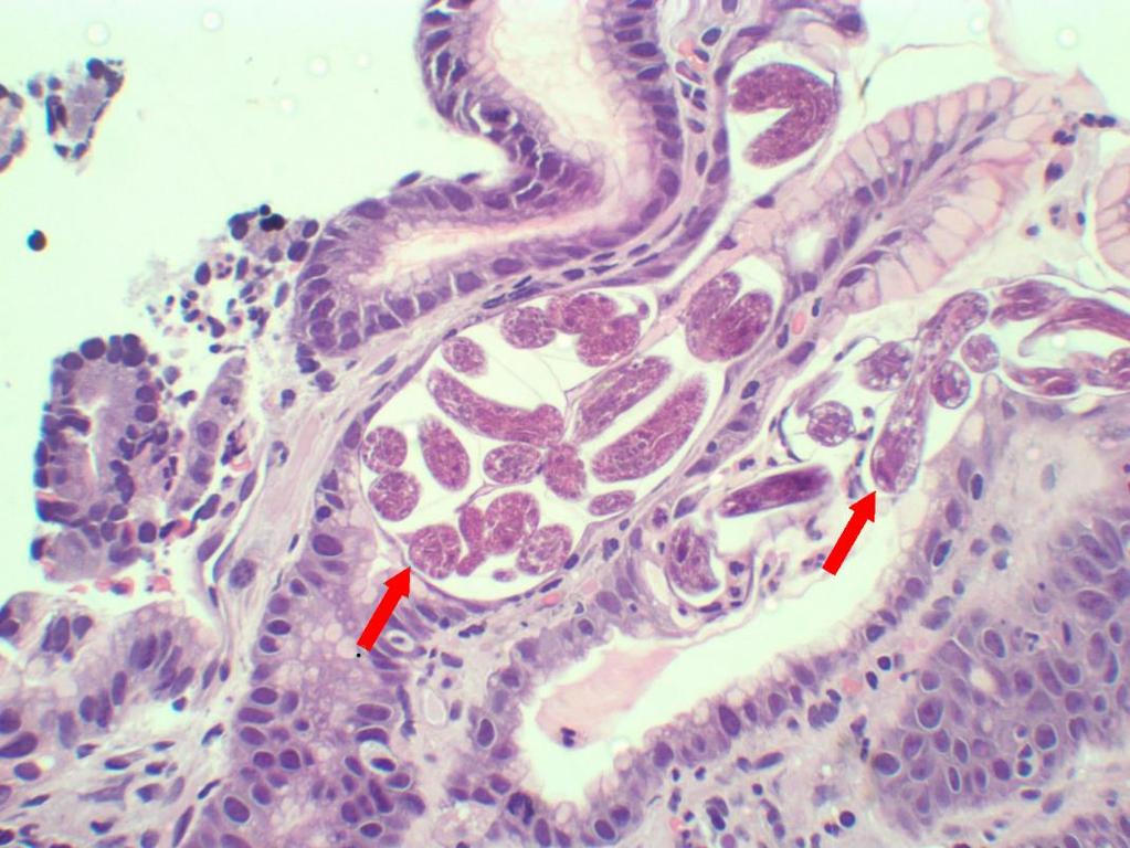 Figura 2. Observam-se larvas rabditoides (setas), permeando epitélio da mucosa gástrica.