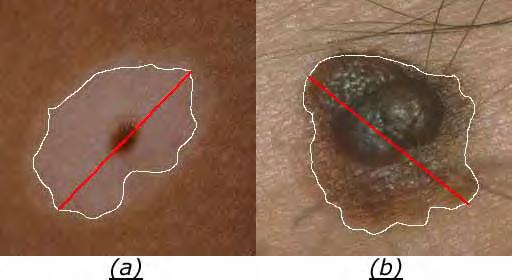 4.1 Comparação de três métodos de extração de características de lesões de pele 87 com a diagonal maior desenhada em vermelho. Figura 4.