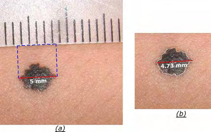 4.1 Comparação de três métodos de extração de características de lesões de pele 88 Figura 4.3: Cálculo do diâmetro da lesão.