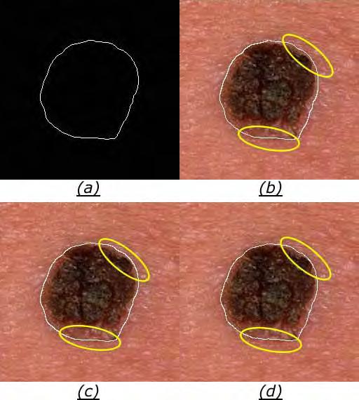 3.5 Pós-processamento do contorno inicial 65 Figura 3.21: Exemplo dos modelos de contorno ativo tradicional (c) e GVF (d), aplicados sobre a curva (a). Em (b) tem-se a curva (a) sobreposta à imagem.