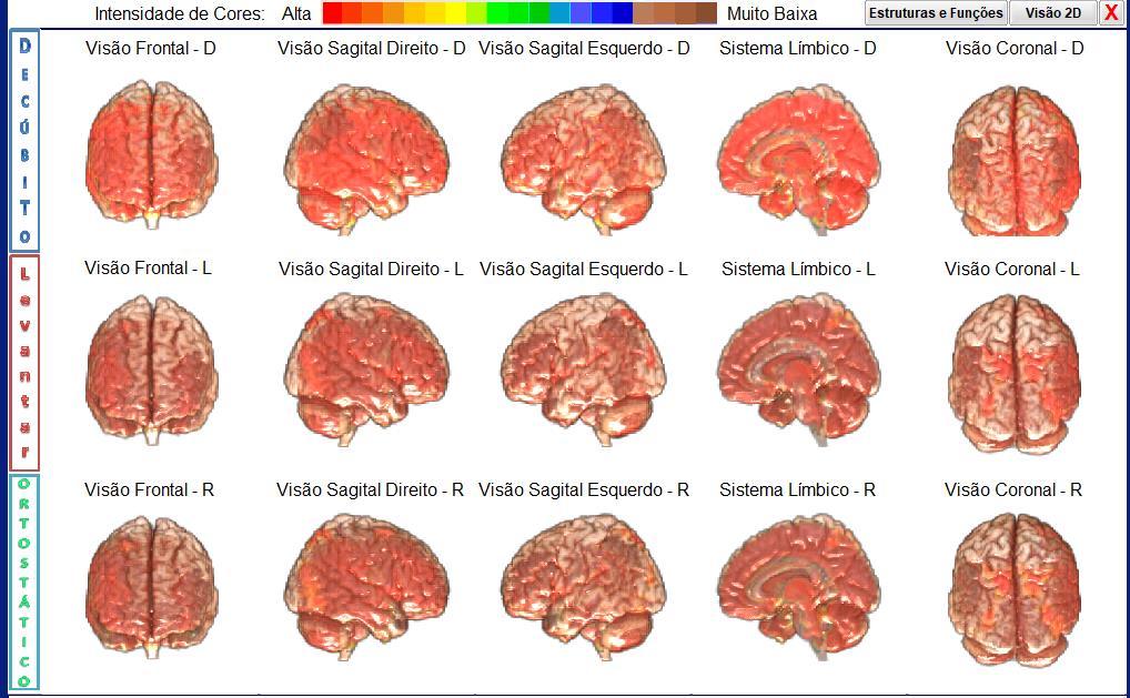 Interpretação do Cérebro Emocional e o Cérebro Racional, A analise mostra que o cérebro apresentou alta atividade durante o DLO nas três posições.