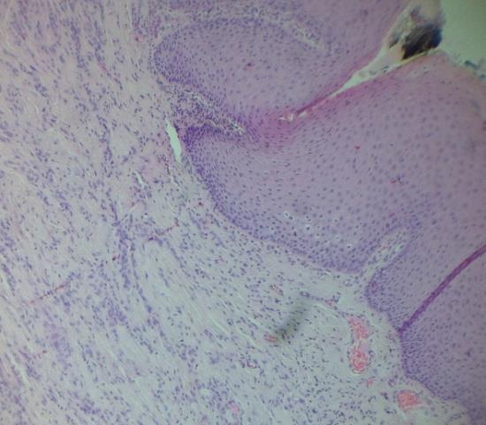 Heitor Santiago Almeida 167 As microfotografias mostram um tecido epitelial escamoso estratificado não queratinizada sem alterações histológicas acima de uma lesão nodular sem bordas definidas que se