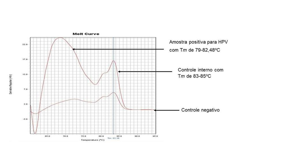 Figura 1. RT-PCR para HPV utilizando os primers MY09-11 e controle interno (β-globina( globina) ) emitido pelo software do equipamento StepOnePlus Real-Time PCR (Applied Biosystems).