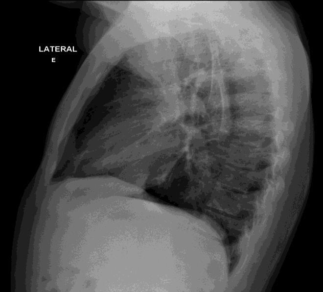 9 Figura 1: Caso 1 Luiz Felipe Nobre (radiologista): Vamos entregar a resposta do primeiro caso. Com isso, uma questão da prova é dada! Trata-se de uma radiografia de tórax normal.