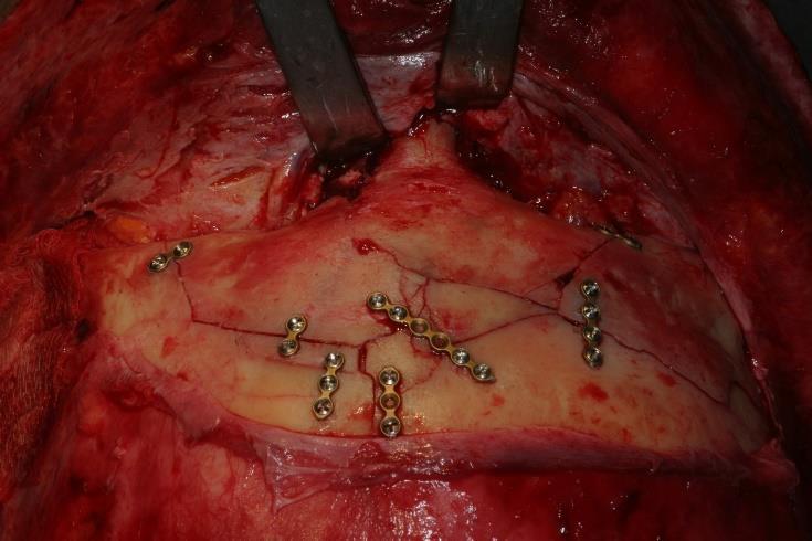 As suturas de acessos cirúrgicos foram realizadas por planos (Figura 5), e os drenos de sucção (Portovac sistema fechado) foram
