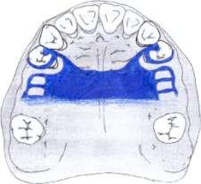 No caso do dente pilar apresentar um quadro periodontal mais grave, mas ainda não indicada a sua extração, independente do arco, estaria indicado Grampo Circunferencial Modelo Anel, mas sem o