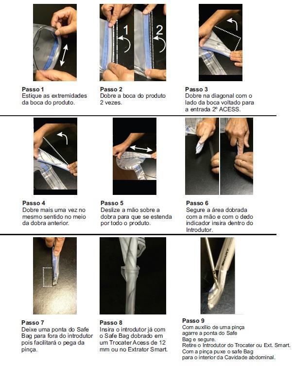 2.1 Procedimento para montagem: Abrir a embalagem (abertura em pétala) utilizando técnicas usuais de assepsia e antissepsia; Retirar a proteção interna da bolsa