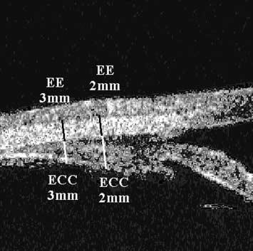 Reprodutibilidade intra-observador de medidas morfométricas do segmento anterior em olhos normais pela biomicroscopia ultra-sônica (UBM) 179 Figura 1 - Representação dos métodos de medida das