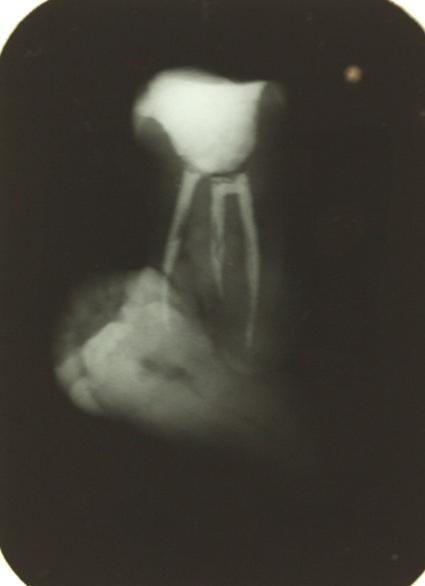 Figura 3: Radiografia periapical pós-cirúrgica evidenciando a união pelo cemento.