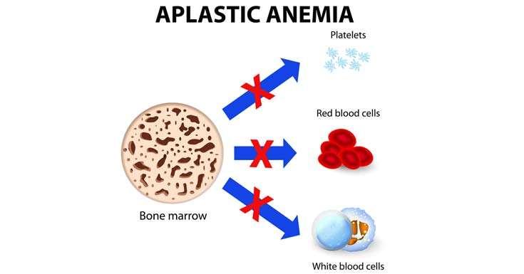 Aplasia de Medula