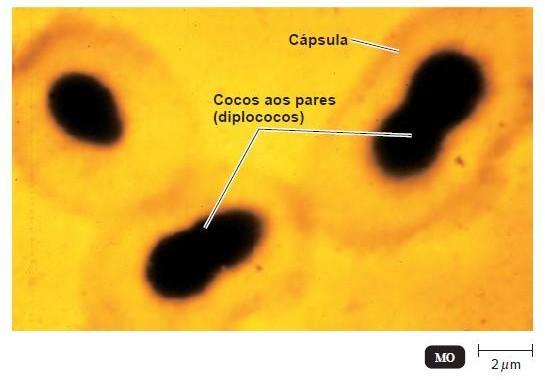 Streptococcus pneumoniae - Diplococos Gram+ ( pneumococo) - Pneumonia típica (pneumonia pneumocócica) - Cápsula polissacarídica: > de 90 sorotipos - α-hemolíticos (não