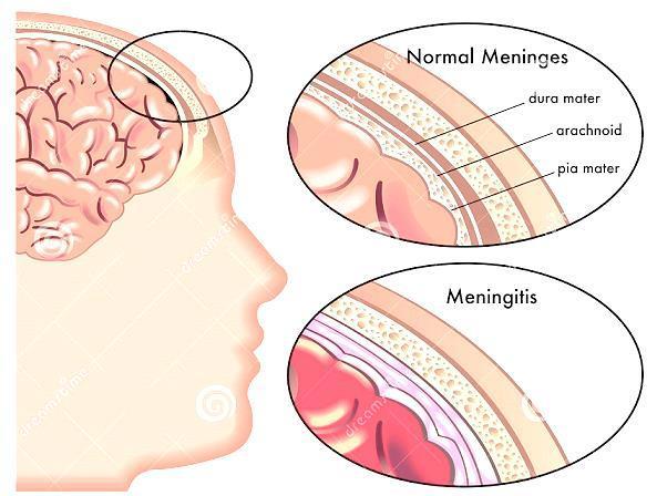 Meningites A meningite é um processo inflamatório da aracnóide, da pia-máter e