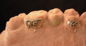 Esta base é confeccionada para regularizar a anatomia da face lingual e a distância vestíbulo-lingual dos dentes; evita que o fio tenha dobras in-set e off-set durante o tratamento ortodôntico.