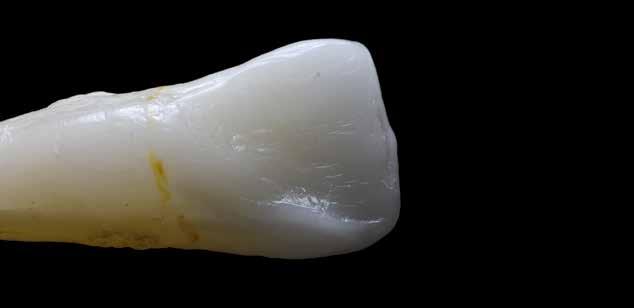 A coroa de um incisivo central superior tem, em média, 10 a 11 mm de altura a partir do ponto mais apical da linha cervical até o ponto mais baixo da margem incisal.