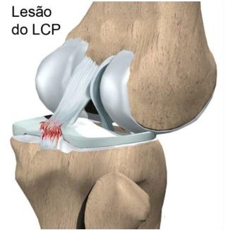 Lesão do Ligamento Cruzado Posterior (LCP) INTRODUÇÃO O ligamento cruzado posterior (LCP) é um dos ligamentos menos lesados do joelho.