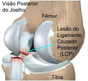 Ele conecta a parte de trás do fêmur (osso da coxa) a parte de trás da tíbia (osso da perna) atrás do LCA.