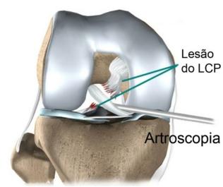 Muitos pacientes recebem tratamento fisioterápico após a lesão do LCP. Os fisioterapeutas tratam o inchaço e a dor com o uso de gelo, estimulação elétrica e períodos de repouso com a perna elevada.
