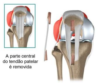 Em uma cirurgia típica, a extremidade rompida do LCP deve ser removida. Uma vez feito, o tipo de enxerto que será usado é determinado. Um dos tendões mais comumente usado é o tendão patelar.