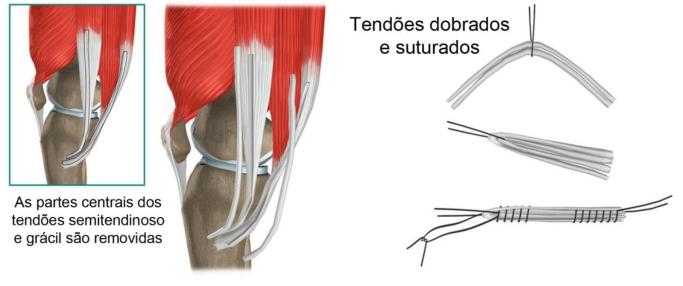 Então são feitos furos na tíbia e no fêmur para se alocar o enxerto. Esses furos são feitos de modo que eles tenham a mesma direção que o LCP original.