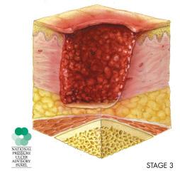 Este estágio pode incluir lesão cavitária. A profundidade da úlcera estágio III varia com a localização anatômica.