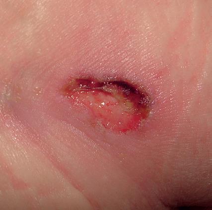 23 Figura 4: Categoria/Grau II: Perda parcial da Espessura da pele Fonte: Úlceras por pressão: Prevenção e Tratamento.