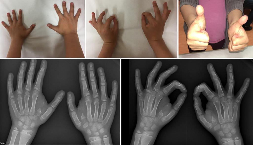 250 Figura 6: Imagens clínicas e radiológicas do resultado pós-operatório nas mãos. Figura 7: Imagens clínicas e radiológicas do resultado pós-operatório nos pés. esteticamente satisfatório.