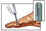 Passo 2: medição da profundidade do fioguia Deslize o medidor de profundida sobre o fuiguia até que ele nivele com o osso. Determine a profundidade a partir da extremidade posterior do fio.